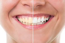 Teeh whitening before and after comparison