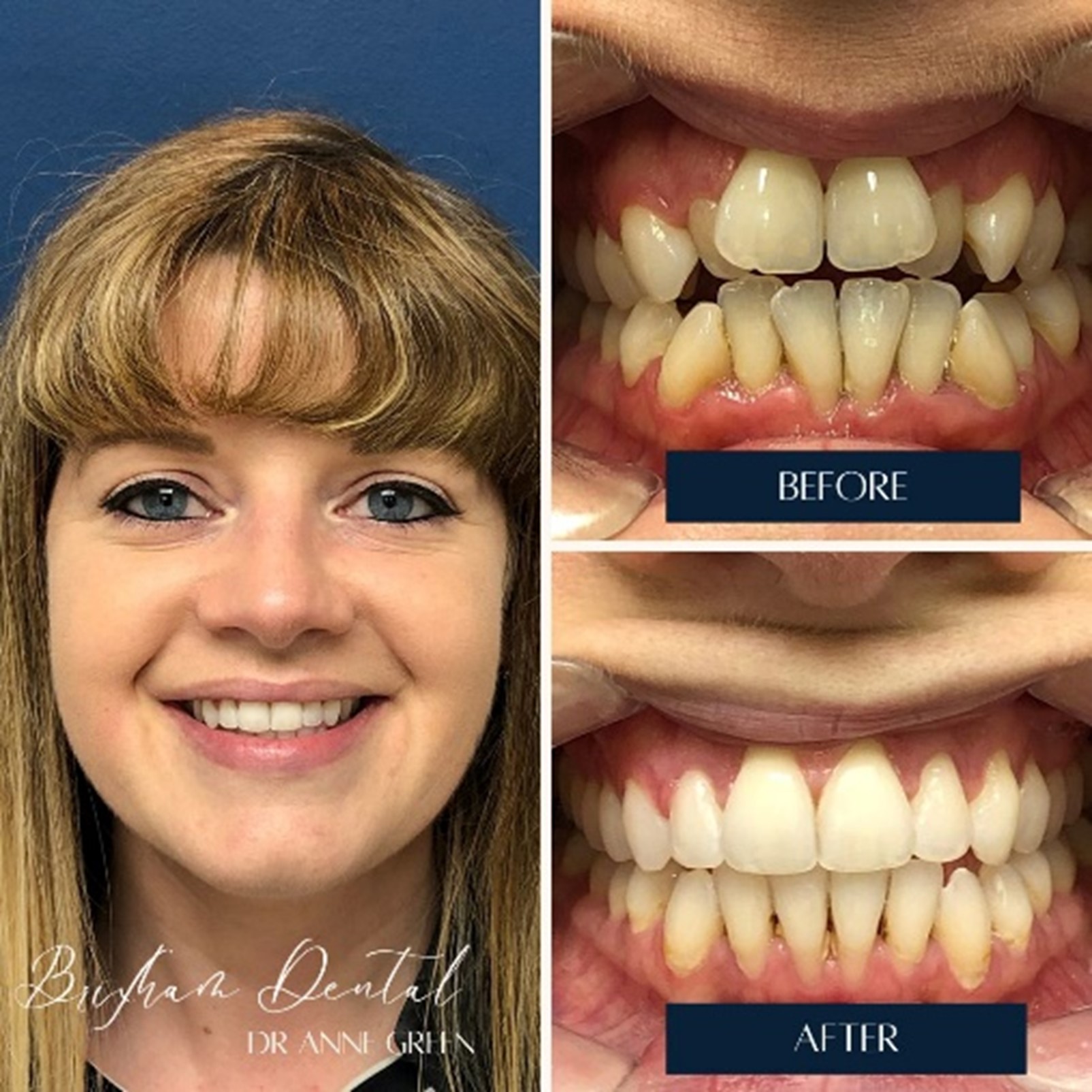 Before and after invisalign treatment