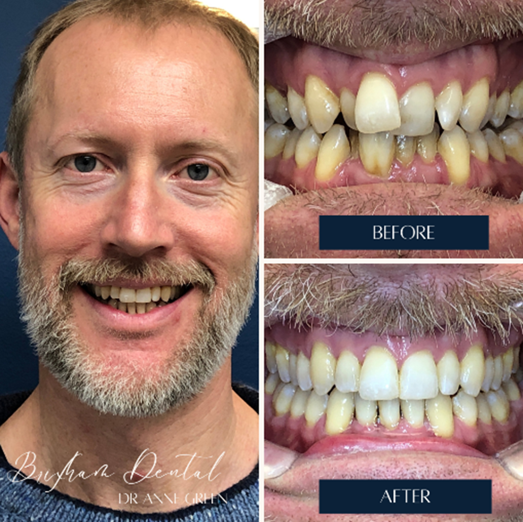 Before and after invisalign treatment