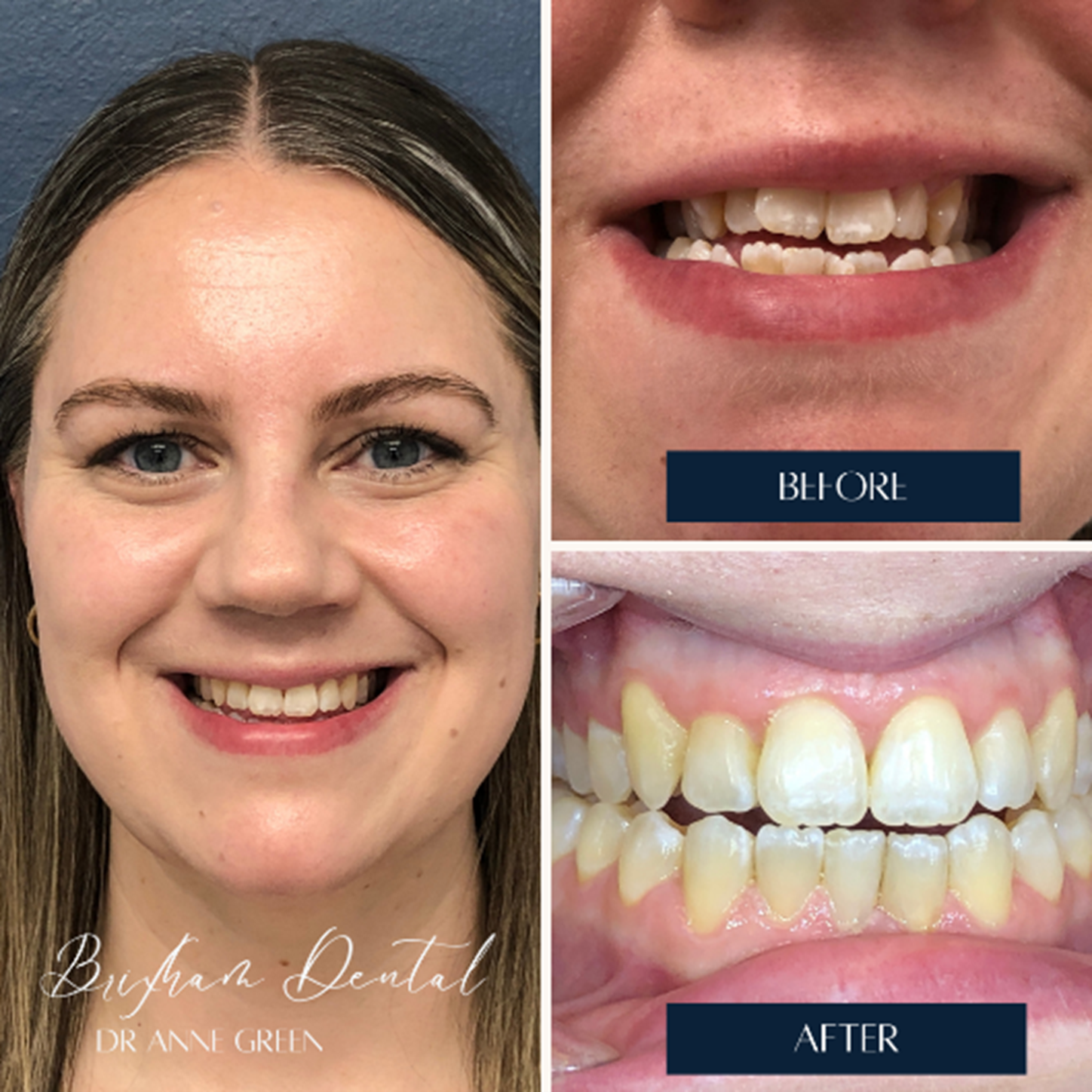 Before and after invisalign treatment