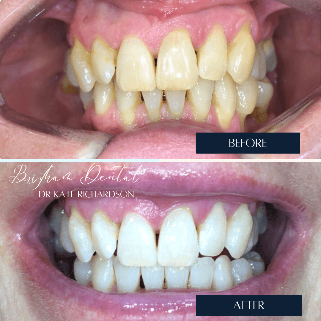 Before and after invisalign treatment