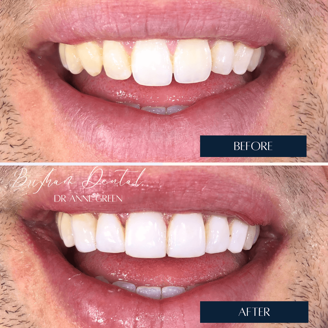 Before and after invisalign treatment