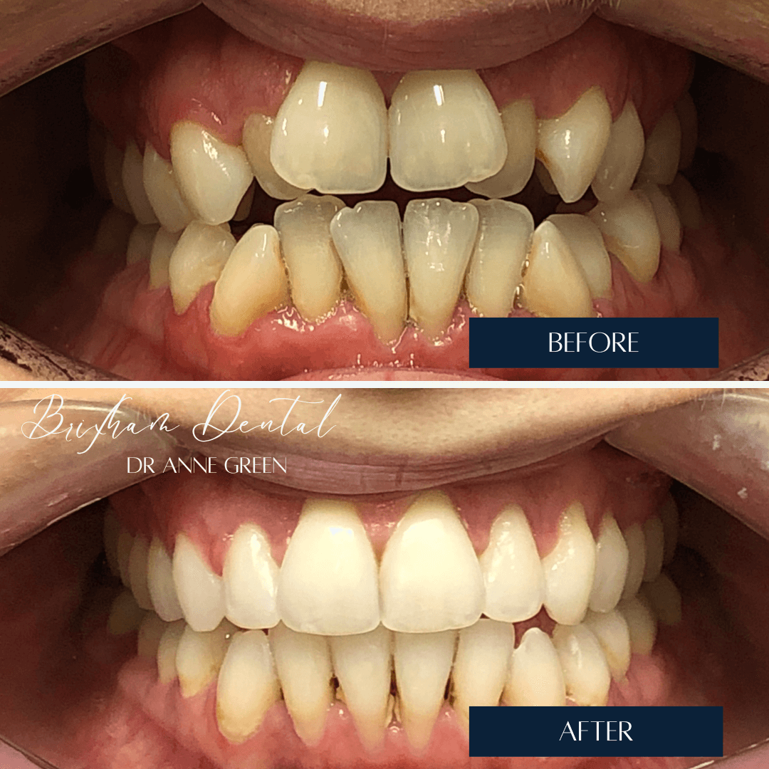 Before and after invisalign treatment