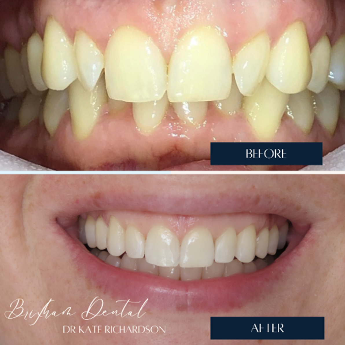 Before and after invisalign treatment