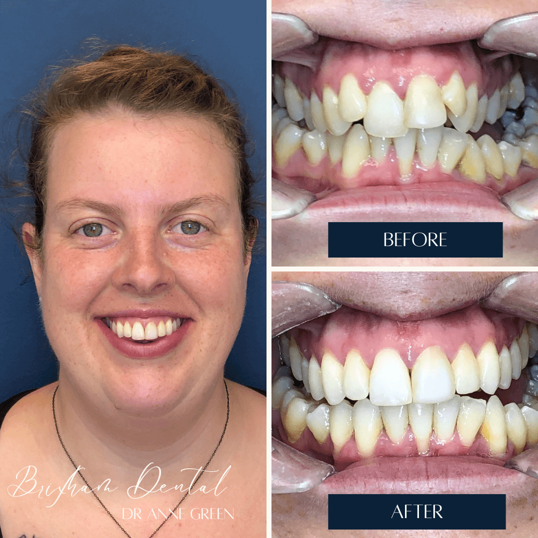 Before and after invisalign treatment