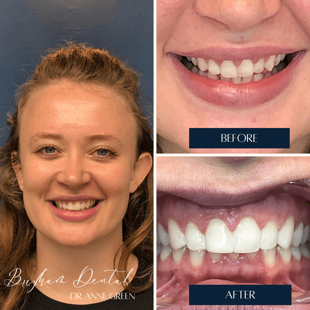 Before and after invisalign treatment