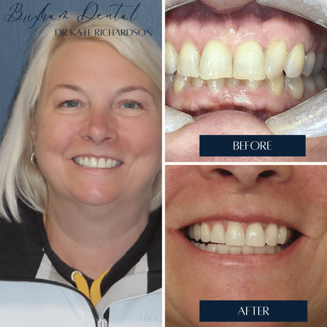 Before and after invisalign treatment