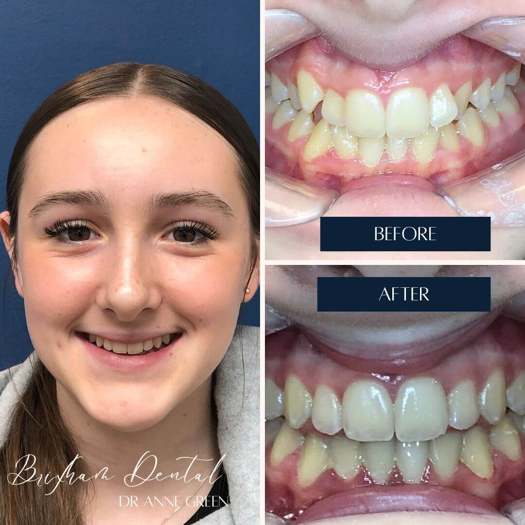 Before and after invisalign treatment