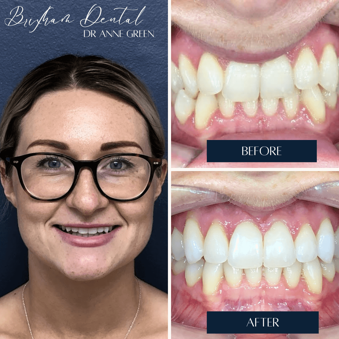 Before and after invisalign treatment