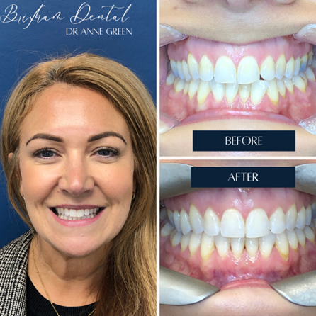 Before and after teeth whitening - Case 4